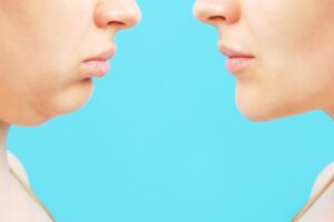 8 φυσικοί τρόποι για να μειώσετε το λίπος στο πρόσωπο χωρίς επέμβαση