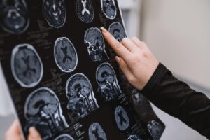 Άνοια: Το πρώτο σημάδι μπορεί να εμφανιστεί δύο δεκαετίες πριν από τα συμπτώματα