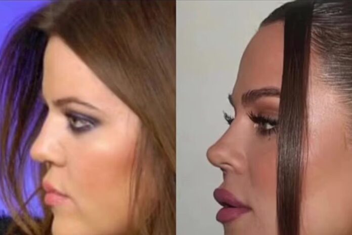 Khloe Kardashian: Πλαστικός χειρουργός εκτιμά ποιες επεμβάσεις έχει κάνει – Τι έχει αλλάξει στο πρόσωπό της