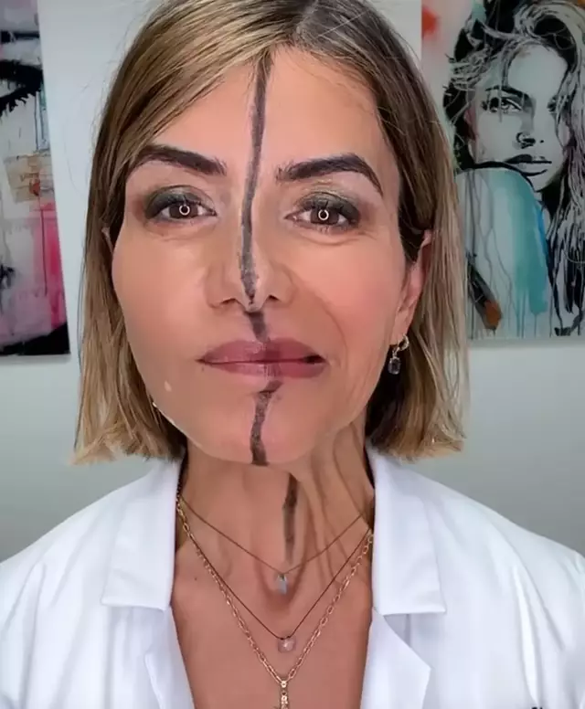 Botox στη μισή όψη: Γιατρός δείχνει την επίδραση στο δέρμα – Εντυπωσιακό βίντεο