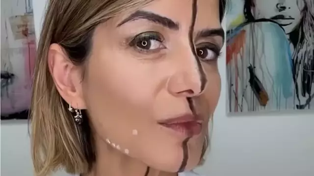 Botox στη μισή όψη: Γιατρός δείχνει την επίδραση στο δέρμα – Εντυπωσιακό βίντεο