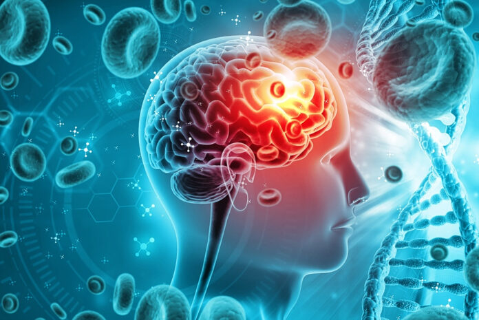 AI: Μπορεί να προβλέψει το Αλτσχάιμερ με ακρίβεια 93%
