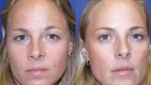 Μελέτη για το botox σε πανομοιότυπες δίδυμες: Φωτογραφίες δείχνουν τις αλλαγές έπειτα από 13 χρόνια