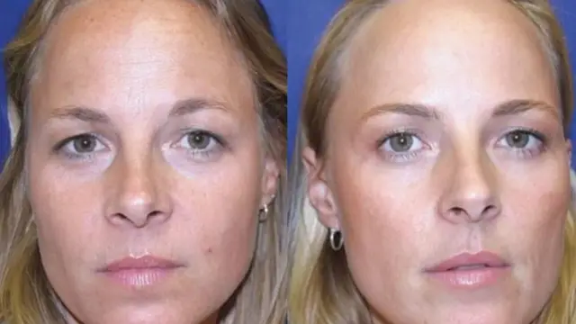 Μελέτη για το botox σε πανομοιότυπες δίδυμες: Φωτογραφίες δείχνουν τις αλλαγές έπειτα από 13 χρόνια