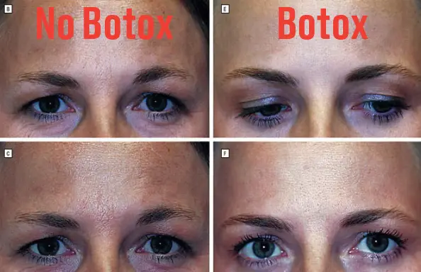 Μελέτη για το botox σε πανομοιότυπες δίδυμες: Φωτογραφίες δείχνουν τις αλλαγές έπειτα από 13 χρόνια