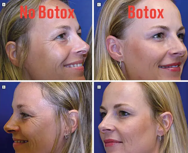 Μελέτη για το botox σε πανομοιότυπες δίδυμες: Φωτογραφίες δείχνουν τις αλλαγές έπειτα από 13 χρόνια