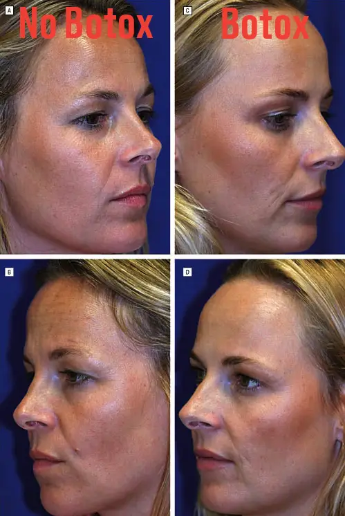 Μελέτη για το botox σε πανομοιότυπες δίδυμες: Φωτογραφίες δείχνουν τις αλλαγές έπειτα από 13 χρόνια
